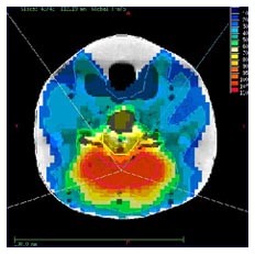 Radioterapia in 4 dimensioni contro i tumori