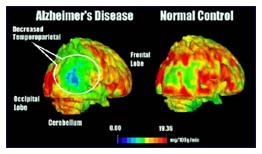 Analisi per l'Alzheimer